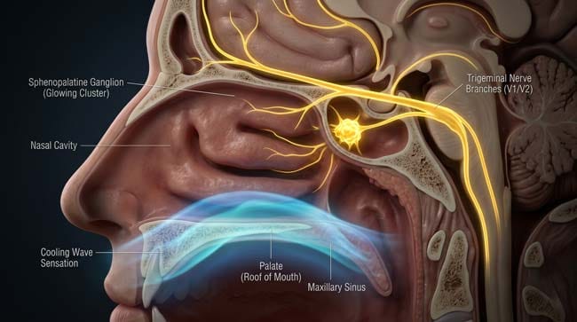 3D medical visualization of sphenopalatine ganglion activation showing why brain freeze happens when cold food contacts the roof of the mouth triggering trigeminal nerve pain