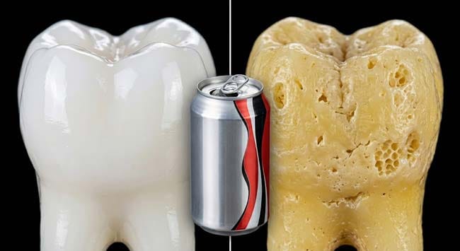 A split comparison of healthy tooth enamel versus cola damaged eroded tooth surface with a cola can in between illustrating how phosphoric acid in cola dissolves enamel and depletes bone calcium through PTH activation