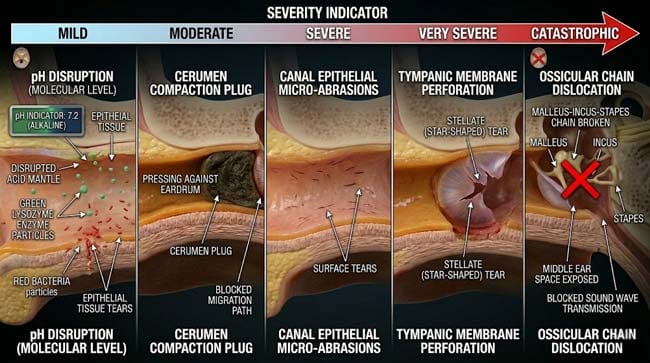 3D five-level spectrum of Q-tip ear damage showing pH microbiome disruption cerumen impaction canal trauma tympanic membrane perforation and ossicular chain dislocation in progressive severity