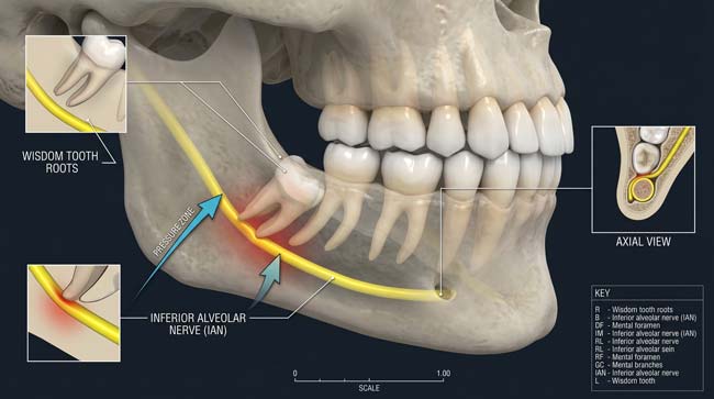 3D visualization of wisdom tooth roots pressing against the inferior alveolar nerve