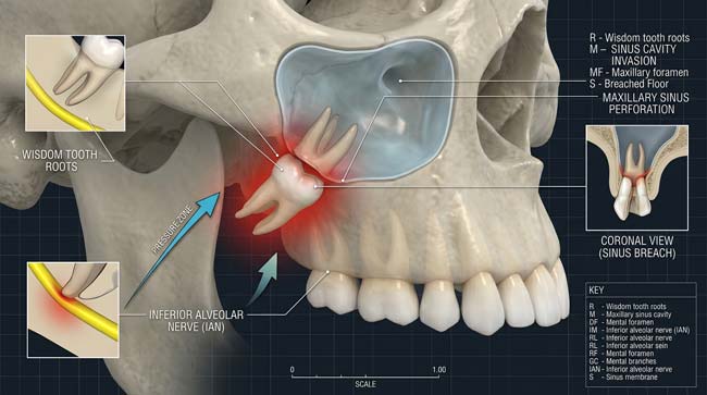 3D simulation of upper wisdom teeth invading the maxillary sinus cavity