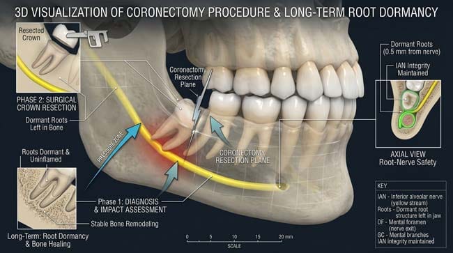 D visualization of a Coronectomy procedure, where the roots are left dormant in the jaw to avoid nerve canal trauma.