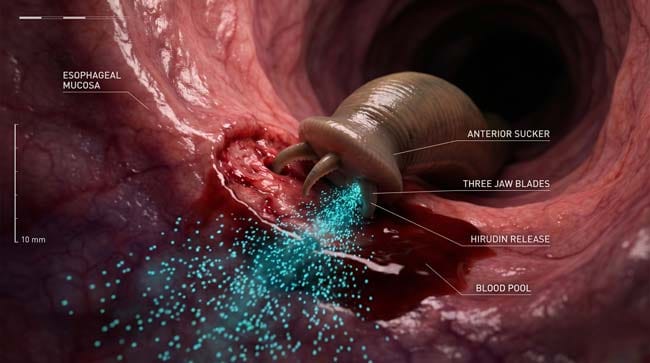 3D medical visualization of a leech attached to esophageal mucosa showing hirudin anticoagulant spreading and internal blood pool formation after swallowing