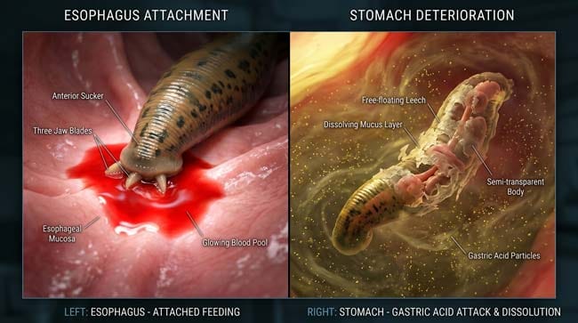 3D medical visualization split-screen showing leech survival outcome: esophageal attachment vs stomach acid dissolution