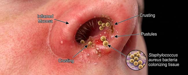 3D render of Nasal Vestibulitis infection caused by Staphylococcus aureus