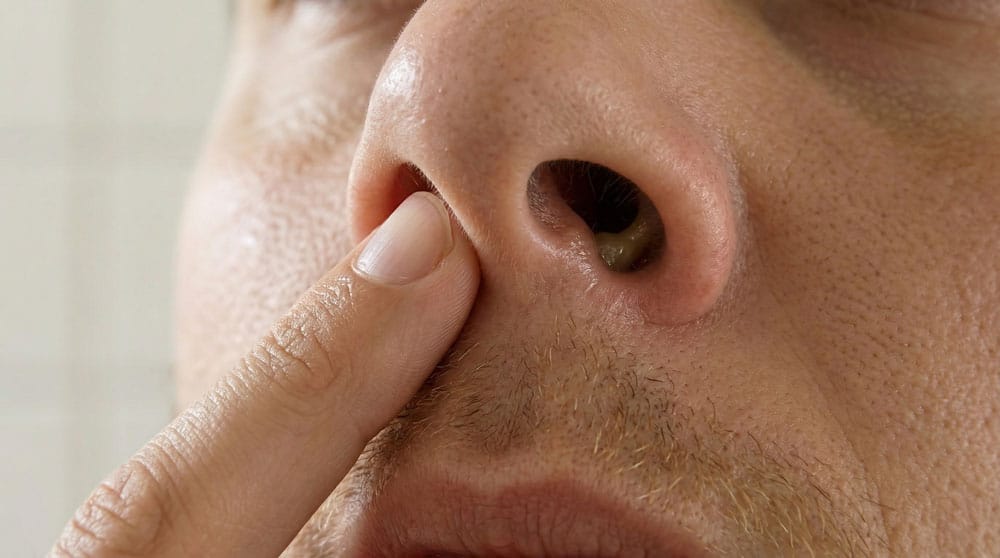 A 3D medical animation showing Nasal Vestibulitis infection caused by nose picking.