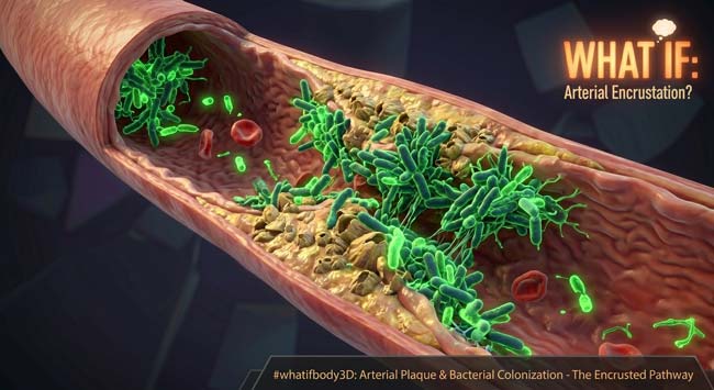 Dramatic 3D animation showing bacteria sticking to blood vessel walls and causing buildup