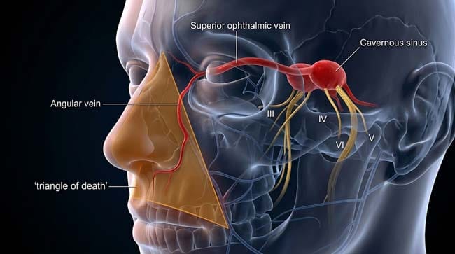 3D transparent facial anatomy showing the triangle of death vascular pathway from angular vein through superior ophthalmic vein to cavernous sinus demonstrating the direct valveless bacterial highway to the skull interior