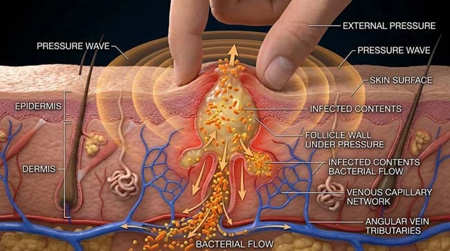 3D cross-section showing pimple squeezing mechanics in the triangle of death with infected bacteria forced into dermal venous network and retrograde flow carrying bacteria toward cavernous sinus through angular vein