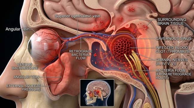 3D visualization of cavernous sinus thrombosis showing infected blood clot compressing cranial nerves and causing eye proptosis after bacteria traveled from a danger triangle pimple through the valveless venous pathway