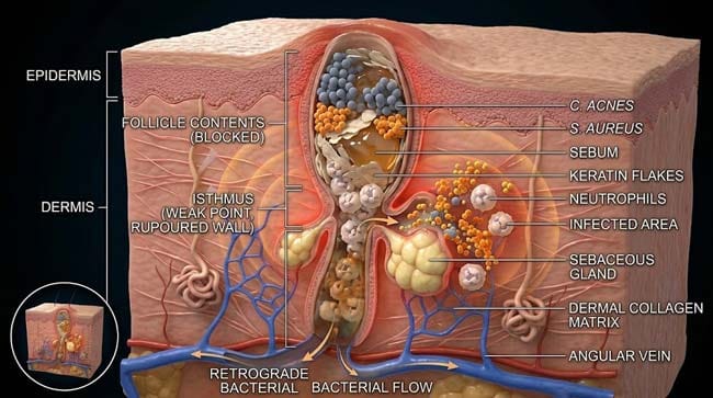 3D cross-section of an inflamed pimple showing follicle unit anatomy with bacteria sebum keratin neutrophils and the thin isthmus wall that represents the primary mechanical weak point under squeeze pressure