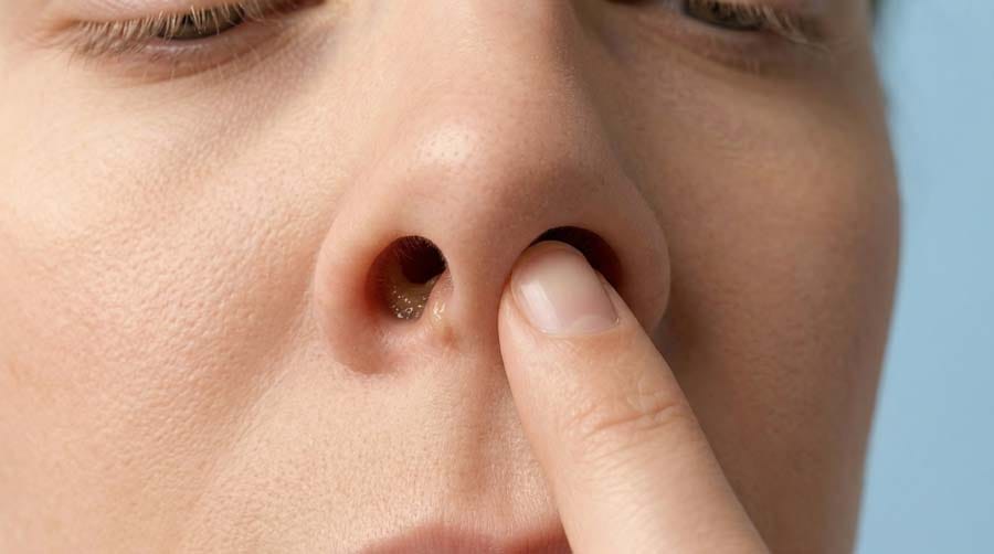 nasal cavity damage from picking nose