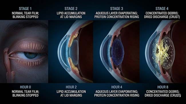 3D four-stage overnight time-lapse showing eye tear film transformation during sleep from normal dynamic film to concentrated protein-mucin-lipid crust accumulating at the medial canthus after 8 hours without blinking