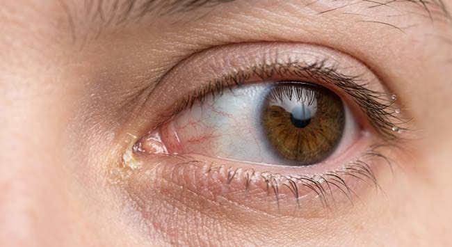 Close-up macro of human eye showing morning eye discharge crust at the medial canthus inner corner illustrating what eye discharge is biochemically composed of and why it accumulates during sleep