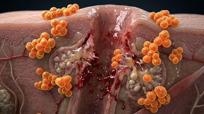3D cross-section showing nose hair plucking trauma with follicle wall tearing at isthmus capillary rupture and immediate Staphylococcus aureus bacterial invasion of the open follicle wound in the nasal vestibule danger triangle