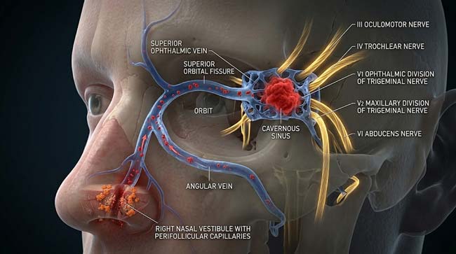 3D transparent facial anatomy showing bacterial pathway from infected nose hair plucking wound through angular vein superior ophthalmic vein into cavernous sinus demonstrating the danger triangle infection route to the skull interior