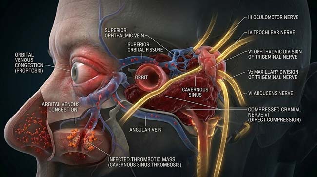 3D visualization of cavernous sinus thrombosis from nose hair plucking infection showing infected clot filling trabeculated sinus compressing cranial nerves III IV V and VI causing proptosis and ophthalmoplegia
